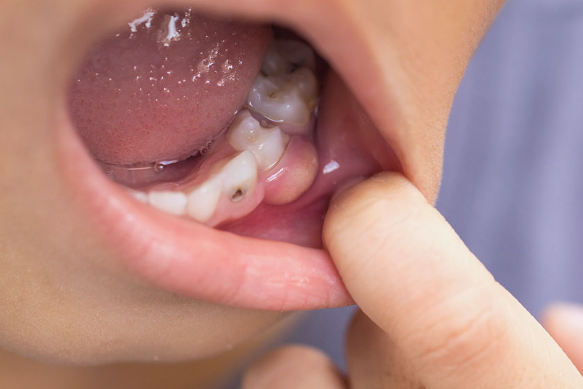 Infezioni Dentali