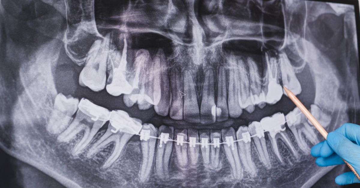 Radiografia dentale