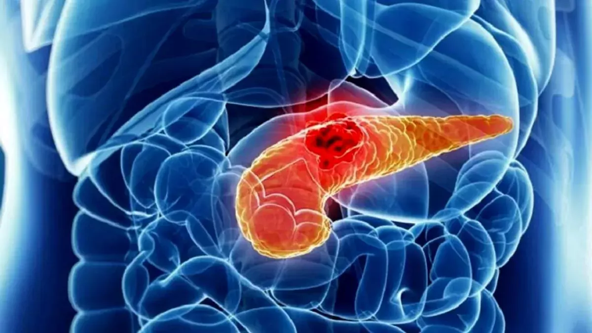 Tumore al Pancreas