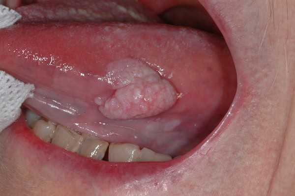 Tumore alla lingua