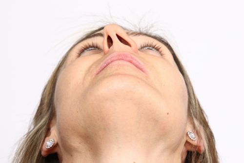 Deviazione del Setto nasale cause