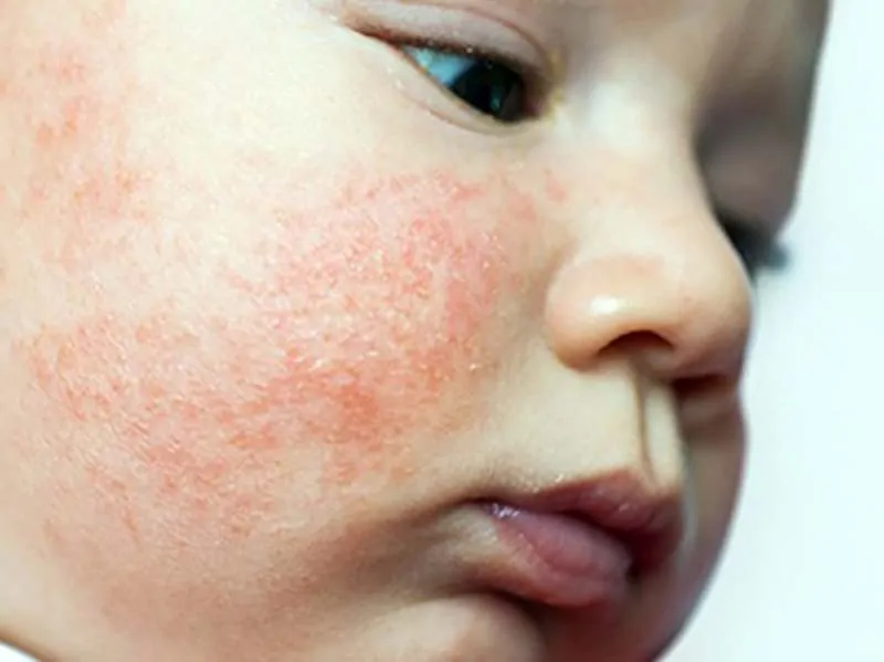 Dermatite Atopica nei Bambini